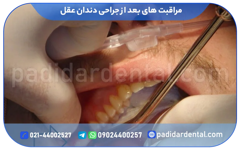 مراقبت های بعد از جراحی دندان عقل