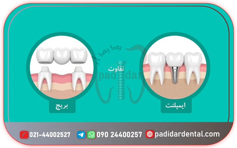 مقایسه ایمپلنت با بریج دندانی