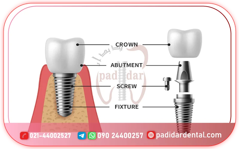 اجزای ایمپلنت دندان