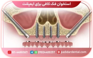 ایمپلنت دندان برای افرادی که استخوان فک کافی ندارند