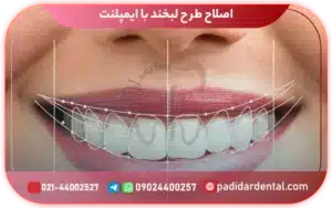 اصلاح طرح لبخند با ایمپلنت