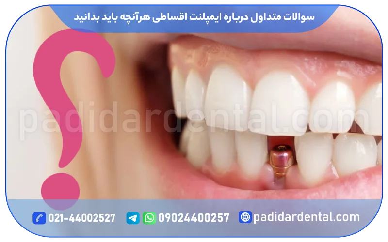 پرسش های متداول درباره ایمپلنت