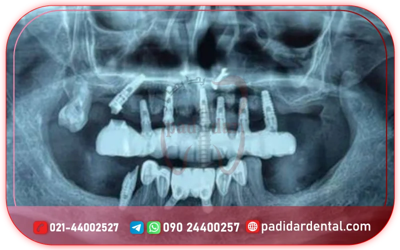 عوارض ناشی از ایمپلنت دندان فوری