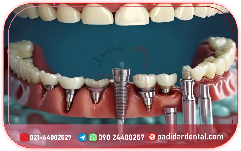 عوامل موثر برای جلوگیری از عوارض نادر ایمپلنت دندان