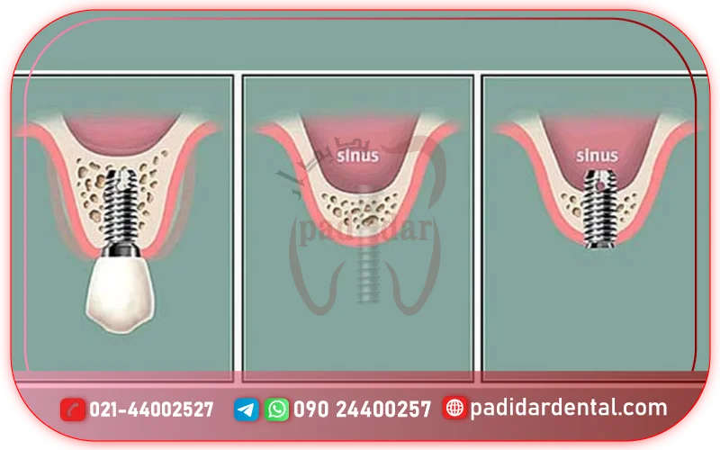 فرق بین ایمپلنت سینوس باز و بسته