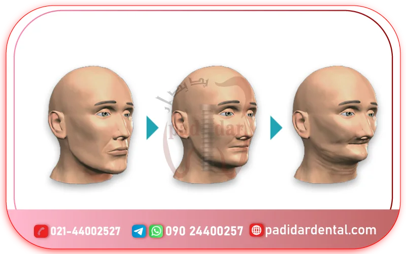 پیشگیری از تحلیل استخوان فک