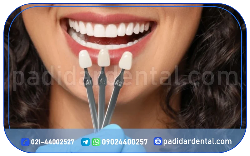 طول عمر لمینت دندان