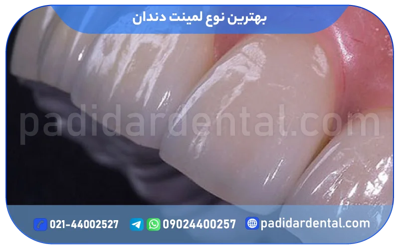 بهترین نوع لمینت دندان