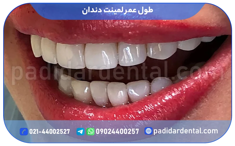 طول عمر لمینت دندان