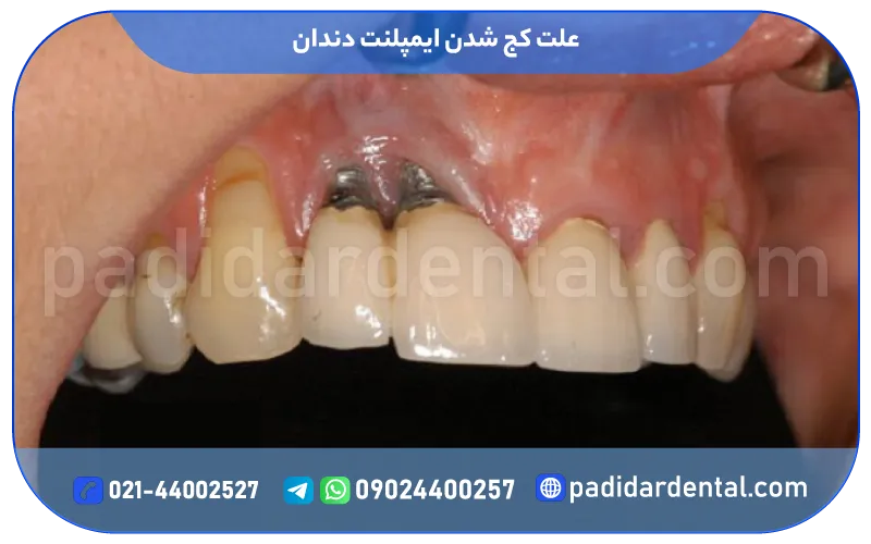 علت کج شدن ایمپلنت دندان