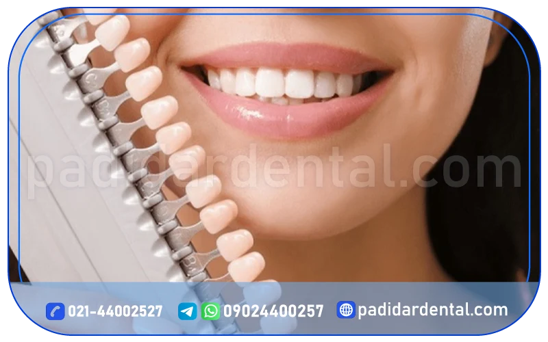 طول عمر لمینت دندان