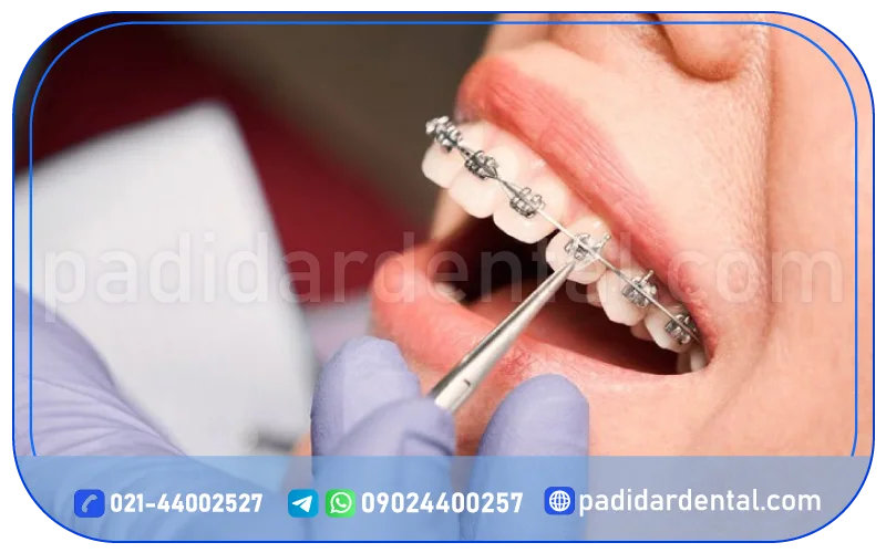 موارد استفاده از ارتودنسی ثابت فلزی