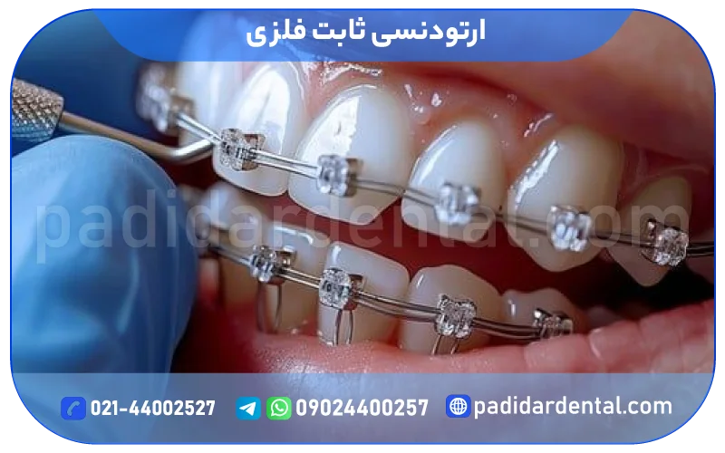 ارتودنسی ثابت فلزی