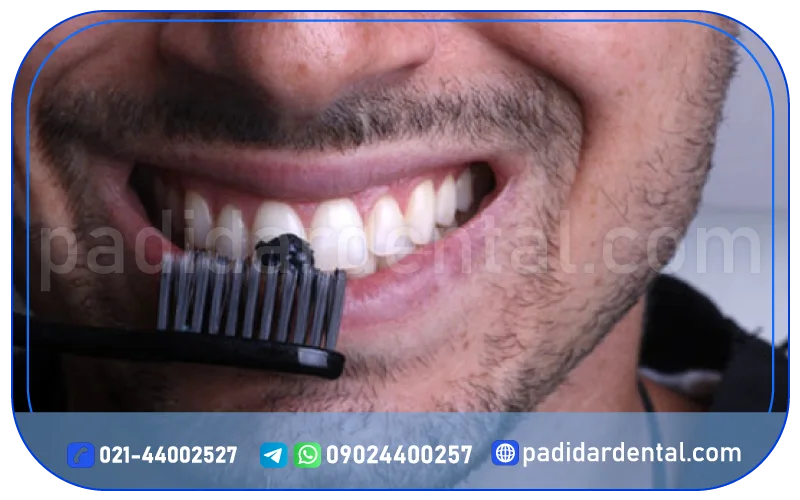 سفید کردن سریع دندان در خانه