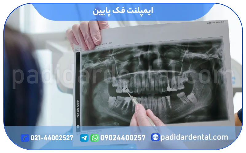 ایمپلنت فک پایین