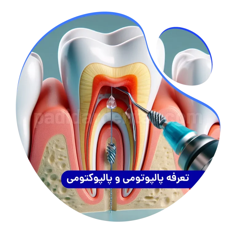 هزینه پالپوتومی و پالپوکتومی