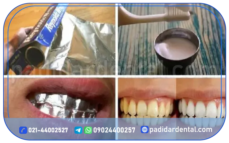چگونه از نتایج سفید کردن دندان در خانه محافظت کنیم؟
