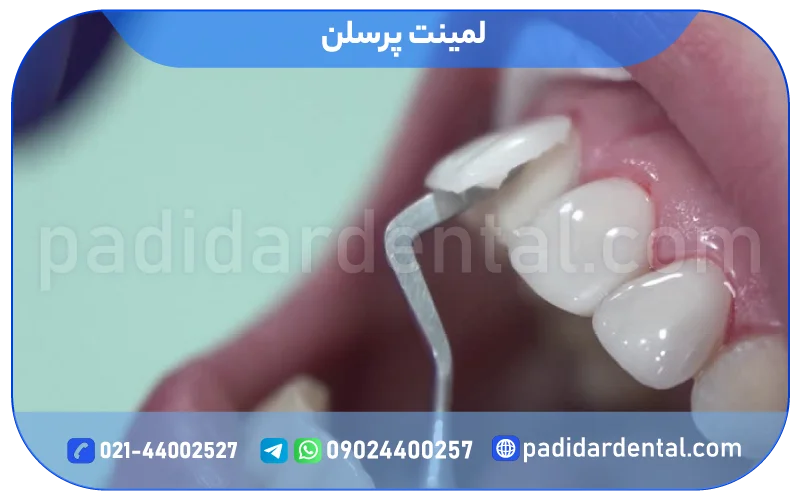 لمینت پرسلن