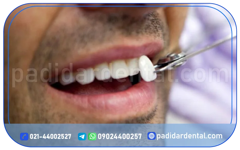 مراحل انجام لمینت سرامیکی کاد کام در کلینیک پدیدار