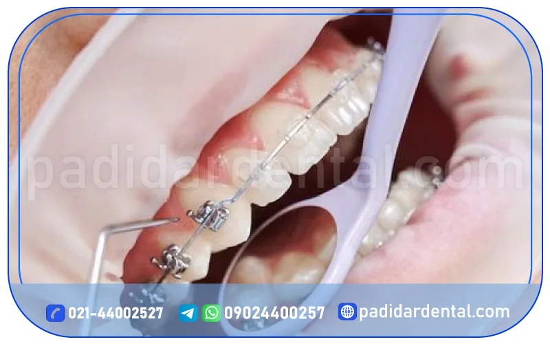 مراحل درمان ارتودنسی ثابت فلزی