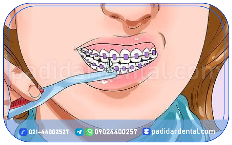 مراقبت های لازم حین درمان ارتودنسی ثابت فلزی