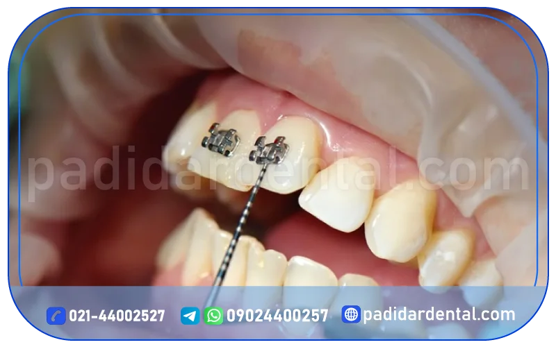 مزایا و معایب ارتودنسی ثابت فلزی