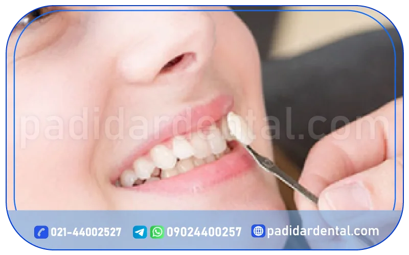 مراقبت های پس از انجام لمینت پرسلن