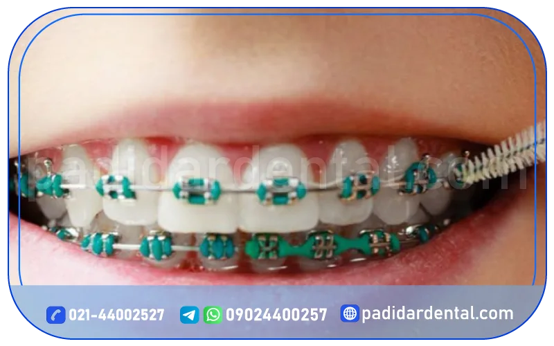 هزینه ارتودنسی ثابت فلزی