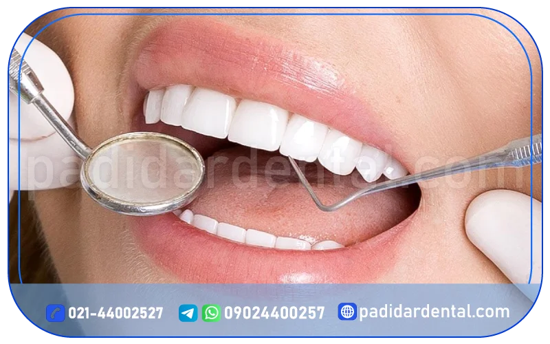 هزینه لمینت سرامیکی کاد کام