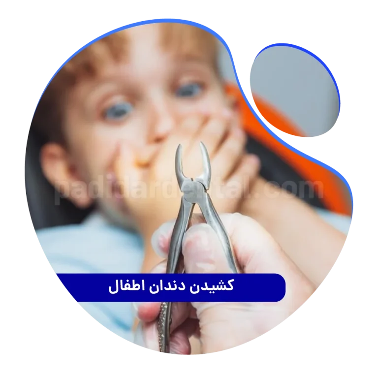 کشیدن دندان اطفال