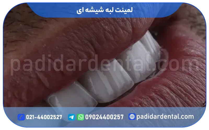 مراحل انجام لمینت لبه شیشه ای