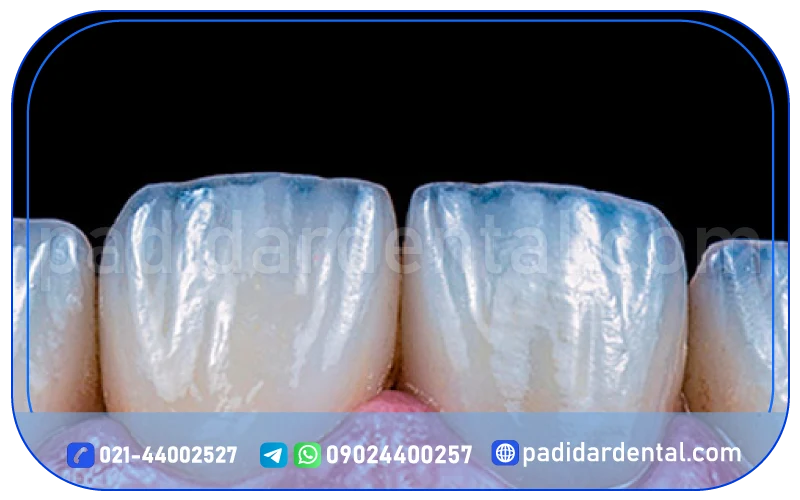 لمینت لبه شیشه ای چیست؟