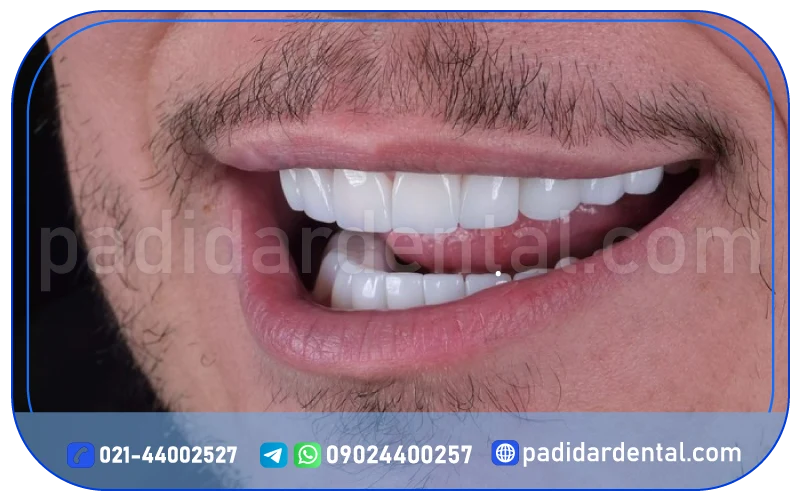 مراحل انجام لمینت لبه شیشه ای