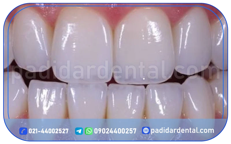 معایب لمینت لبه شیشه ای